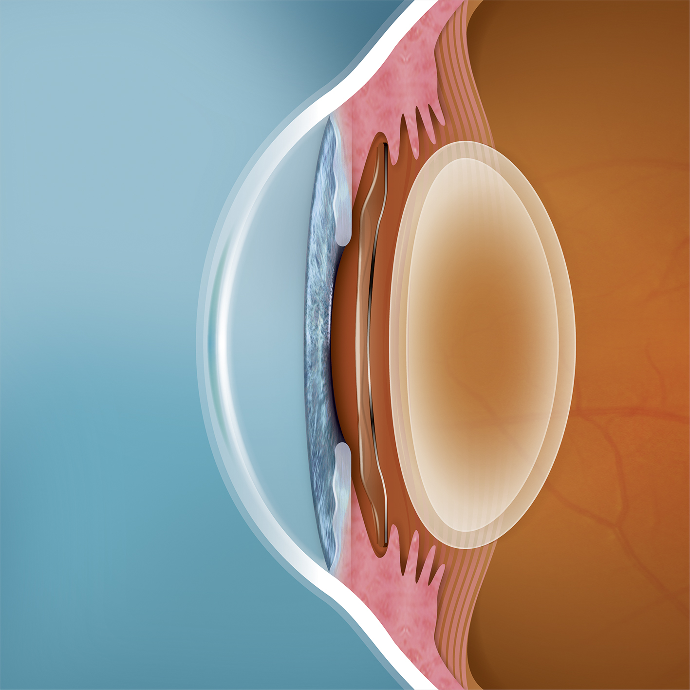 Lentes ICL: Seguridad, indoloras y cómodas.
