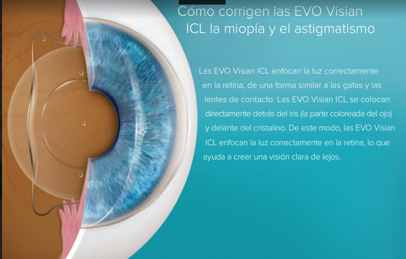 Cómo corrigen las EVO Visian ICL la miopía y el astigmatismo