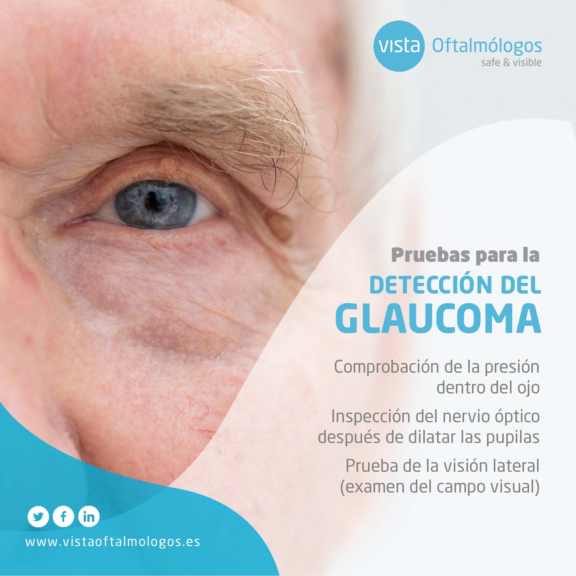 ¿Qué es el glaucoma?