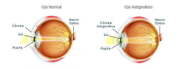 Ilustración que muestra la diferencia entre un ojo normal y otro con astigmatismo