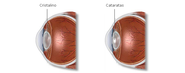 Ilustración que muestra la diferencia entre un ojo normal y otro con cataratas