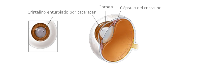 Como se realiza una cirugía de cataratas