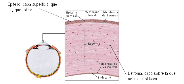 Ilustración sobre cirugía refractiva