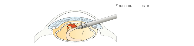 Realización de una facoemulsificación