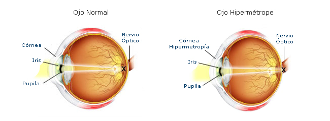 Ilustración que muestra la diferencia entre un ojo normal y otro con hipermetropía