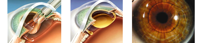Secuela de la implantación de una lente