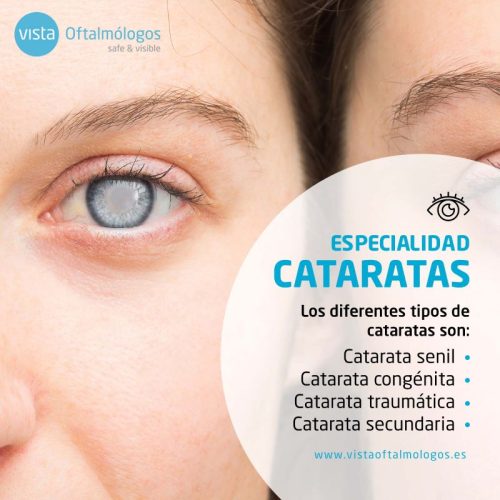 cataratas def