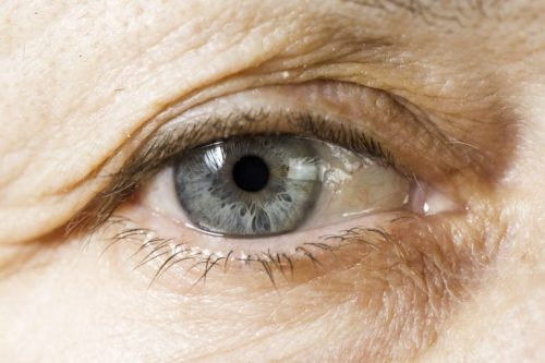 glaucoma